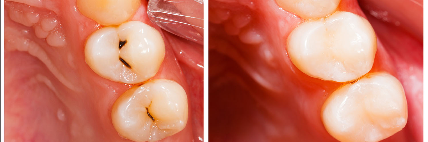 The image shows a close-up view of a human mouth with teeth that have been prepared for dental implants, revealing holes where the teeth will be placed.