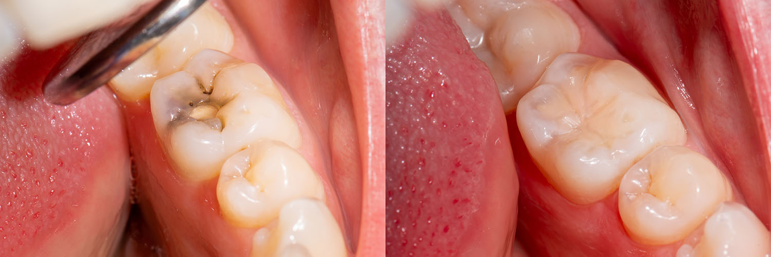 An extreme close-up of a human mouth with multiple teeth showing signs of decay and damage, including cavities and broken edges, set against a blurred background.